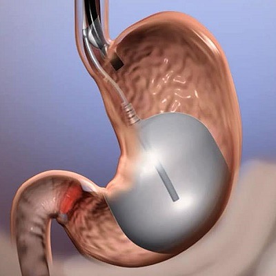 The Truth About Gastric Balloon Placement for Fat Reduction