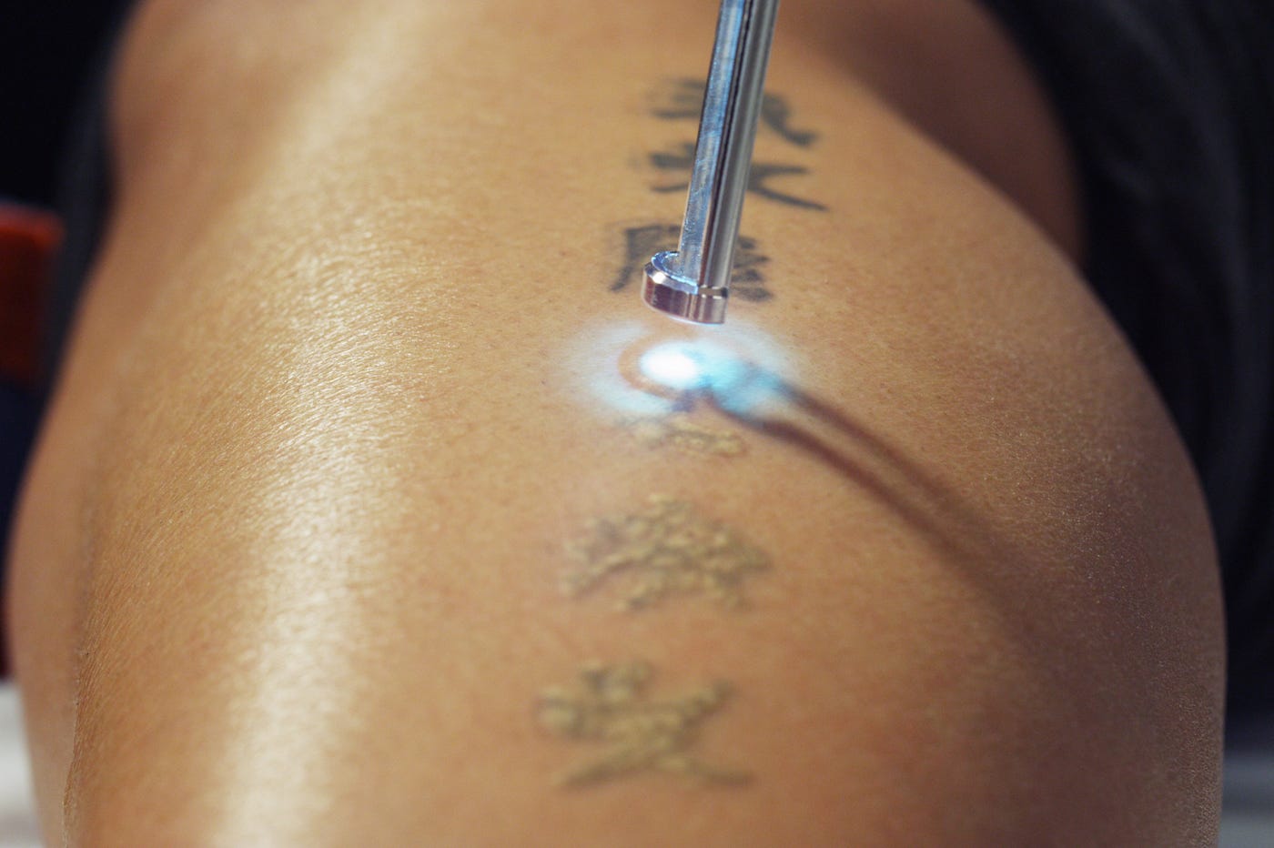 Get Smooth, Tattoo-Free Skin with Laser Tattoo Removal