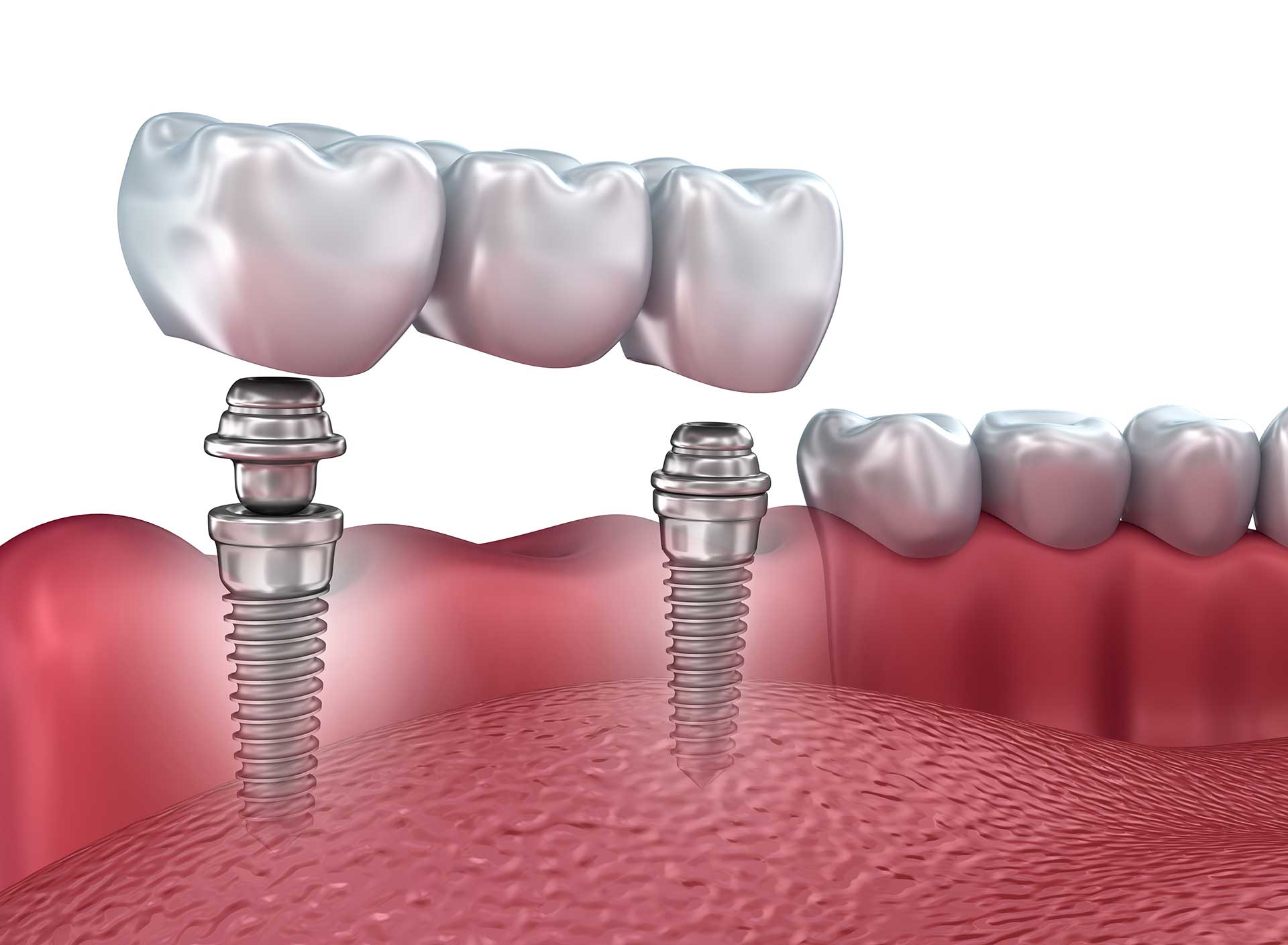 How Dental Implants Maintain Jaw Strength