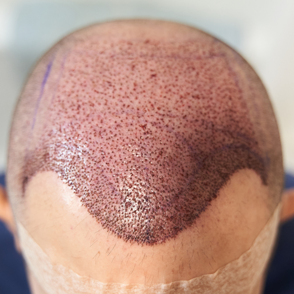 How Do I Know If Hair Transplant Is Right for Me?