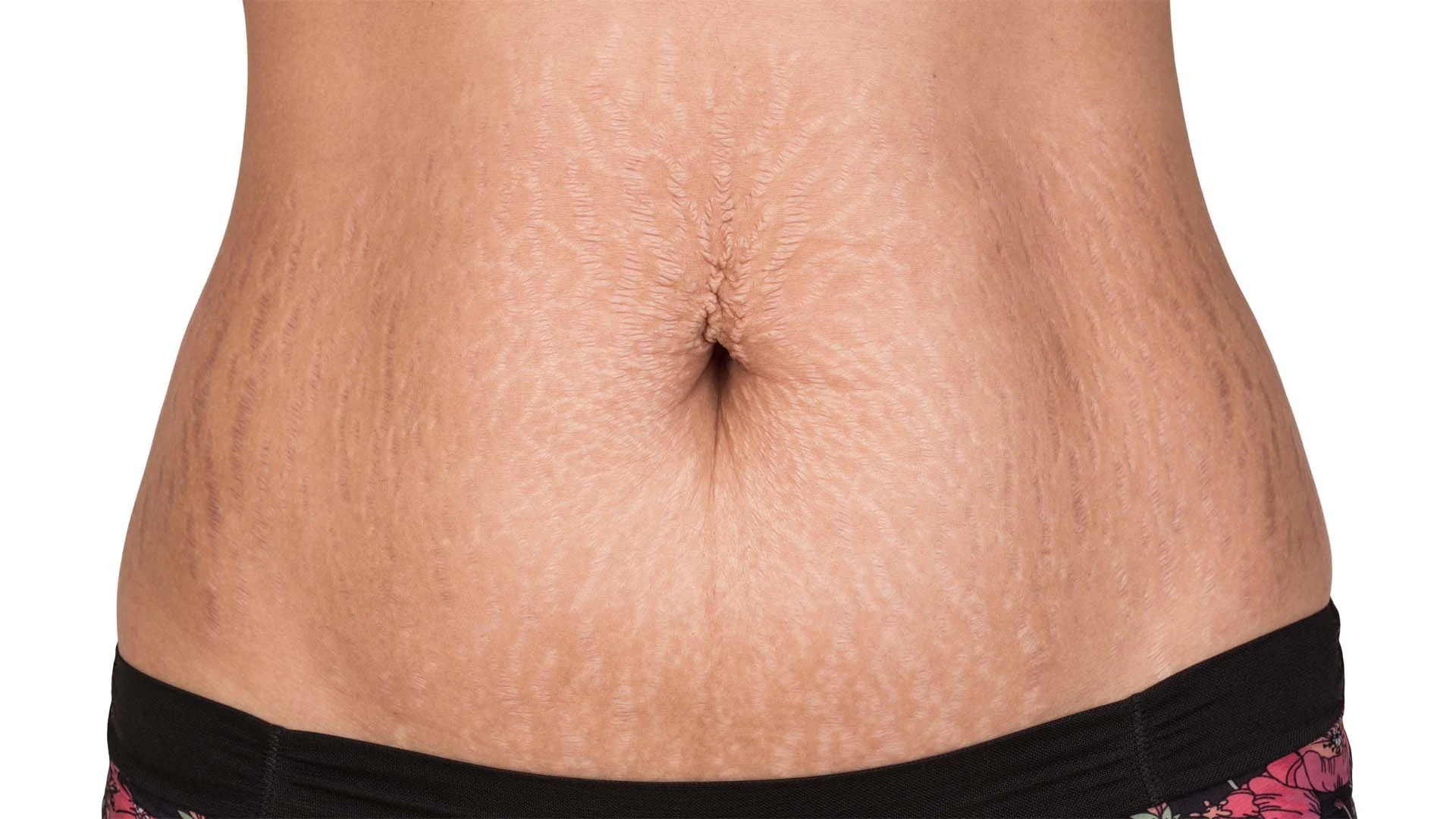 How Long Does It Take to Remove Stretch Marks