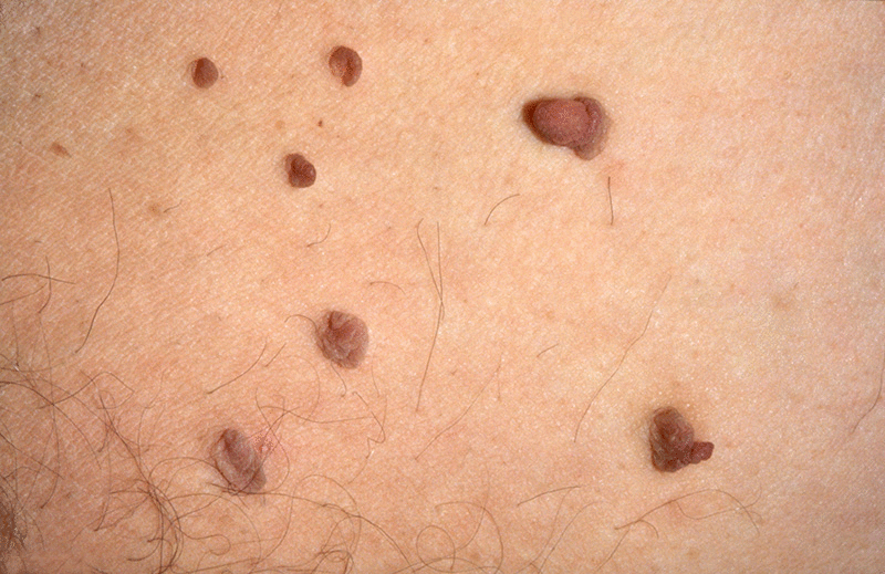 How to Remove Skin Tags on Inner Thigh Without Surgery