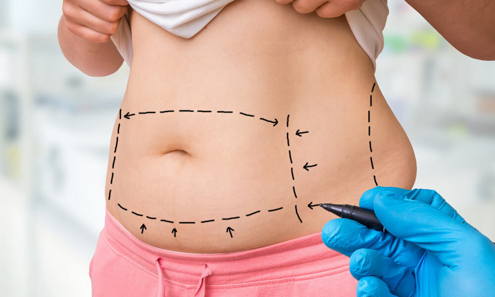 Mini Abdominoplasty: A Quick Fix for a Flatter Abdomen