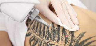 Pico Laser Tattoo Removal Dubai