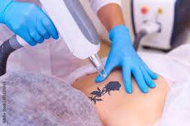 Navigating the Recovery Process After Pico Laser Tattoo Removal